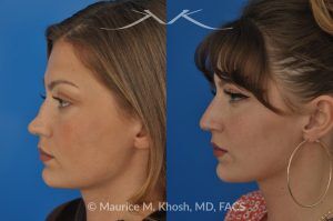 Photo of a patient before and after a procedure. Rhinoplasty to Correct Saddle Nose Deformity Caused by Autoimmune Condition - 27 year old with saddle nose collapse due to an autoimmune condition. She was bothered by the unnatural sag of the bridge of the nose, loss of nasal tip definition, and nasal obstruction. Her own rib cartilage was used during saddle nose rhinoplasty, to reconstruct the nose and restore breathing. The last two images show the computer simulation of surgical outcome (middle picture), as well as the final outcome (the picture on the right side). Patient is delighted with her results. 