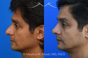 Photo of a patient before and after a procedure. Rhinoplasty for Hump Reduction, Tip Elevation, and Nasal Refinement - Rhinoplasty was performed through the open approach to reduce the nasal hump (radix graft as well as dorsal shave), elevate the tip (septo-columellar sutures), and refine the lower nose (alar strut grafts and cephalic trimming). The patient is ecstatic about the final outcome which is completely natural and perfectly complementary to his face. 