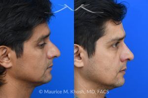 Photo of a patient before and after a procedure. Rhinoplasty for Hump Reduction, Tip Elevation, and Nasal Refinement - Rhinoplasty was performed through the open approach to reduce the nasal hump (radix graft as well as dorsal shave), elevate the tip (septo-columellar sutures), and refine the lower nose (alar strut grafts and cephalic trimming). The patient is ecstatic about the final outcome which is completely natural and perfectly complementary to his face. 