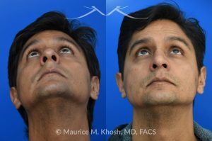Photo of a patient before and after a procedure. Rhinoplasty for Hump Reduction, Tip Elevation, and Nasal Refinement - Rhinoplasty was performed through the open approach to reduce the nasal hump (radix graft as well as dorsal shave), elevate the tip (septo-columellar sutures), and refine the lower nose (alar strut grafts and cephalic trimming). The patient is ecstatic about the final outcome which is completely natural and perfectly complementary to his face. 