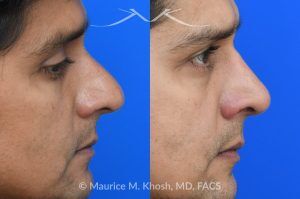 Photo of a patient before and after a procedure. Rhinoplasty for Hump Reduction, Tip Elevation, and Nasal Refinement - Rhinoplasty was performed through the open approach to reduce the nasal hump (radix graft as well as dorsal shave), elevate the tip (septo-columellar sutures), and refine the lower nose (alar strut grafts and cephalic trimming). The patient is ecstatic about the final outcome which is completely natural and perfectly complementary to his face. 