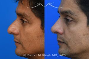 Photo of a patient before and after a procedure. Rhinoplasty for Hump Reduction, Tip Elevation, and Nasal Refinement - Rhinoplasty was performed through the open approach to reduce the nasal hump (radix graft as well as dorsal shave), elevate the tip (septo-columellar sutures), and refine the lower nose (alar strut grafts and cephalic trimming). The patient is ecstatic about the final outcome which is completely natural and perfectly complementary to his face. 
