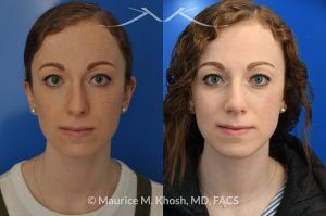 Photo of a patient before and after a procedure. Nasal Hump Reduction and Tip Elevation - This 27 year old requested rhinoplasty in New York to address a large nasal hump and to improve the nasal tip in a subtle and natural manner. The images show her before and after photos 6 months after surgery. The last two images show our computer simulation of the appearance of the bridge of her nose, in the middle images. Note the similarity of the simulation photos to the final outcome. 