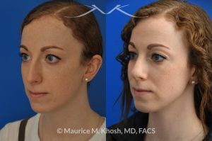 Photo of a patient before and after a procedure. Nasal Hump Reduction and Tip Elevation - This 27 year old requested rhinoplasty in New York to address a large nasal hump and to improve the nasal tip in a subtle and natural manner. The images show her before and after photos 6 months after surgery. The last two images show our computer simulation of the appearance of the bridge of her nose, in the middle images. Note the similarity of the simulation photos to the final outcome. 