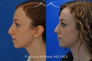 Photo of a patient before and after a procedure. Nasal Hump Reduction and Tip Elevation - This 27 year old requested rhinoplasty in New York to address a large nasal hump and to improve the nasal tip in a subtle and natural manner. The images show her before and after photos 6 months after surgery. The last two images show our computer simulation of the appearance of the bridge of her nose, in the middle images. Note the similarity of the simulation photos to the final outcome. 