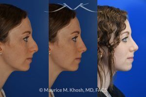 Photo of a patient before and after a procedure. Nasal Hump Reduction and Tip Elevation - This 27 year old requested rhinoplasty in New York to address a large nasal hump and to improve the nasal tip in a subtle and natural manner. The images show her before and after photos 6 months after surgery. The last two images show our computer simulation of the appearance of the bridge of her nose, in the middle images. Note the similarity of the simulation photos to the final outcome. 