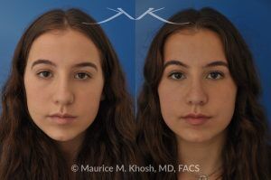 Photo of a patient before and after a procedure. Natural Rhinoplasty: Smoothing the Hump & Refining the Tip - before-and-after composite photo.