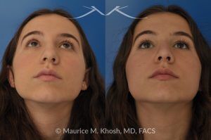 Photo of a patient before and after a procedure. Natural Rhinoplasty: Smoothing the Hump & Refining the Tip - before-and-after composite photo.