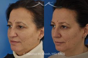 Photo of a patient before and after a procedure. Nose Job for Drooping Tip and Dorsal Hump Correction - This patient underwent rhinoplasty to correct a prominent dorsal hump and a drooping nasal tip. The procedure focused on refining the nasal profile and achieving a more balanced, elevated tip. The results improved both the appearance and harmony of the patient’s facial features.