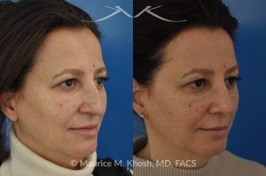 Photo of a patient before and after a procedure. Nose Job for Drooping Tip and Dorsal Hump Correction - This patient underwent rhinoplasty to correct a prominent dorsal hump and a drooping nasal tip. The procedure focused on refining the nasal profile and achieving a more balanced, elevated tip. The results improved both the appearance and harmony of the patient’s facial features.