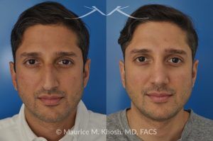 Photo of a patient before and after a procedure. Open Rhinoplasty and Septoplasty for Hump Reduction, Tip Elevation, and Improved Breathing - This procedure involved an open rhinoplasty technique to effectively reduce a prominent nasal hump and elevate a droopy nasal tip for enhanced facial harmony. Additionally, septoplasty was performed to correct nasal septum deviation, improving the patient’s breathing function.