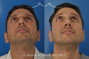 Photo of a patient before and after a procedure. Open Rhinoplasty and Septoplasty for Hump Reduction, Tip Elevation, and Improved Breathing - This procedure involved an open rhinoplasty technique to effectively reduce a prominent nasal hump and elevate a droopy nasal tip for enhanced facial harmony. Additionally, septoplasty was performed to correct nasal septum deviation, improving the patient’s breathing function.