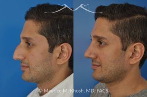 Photo of a patient before and after a procedure. Open Rhinoplasty and Septoplasty for Hump Reduction, Tip Elevation, and Improved Breathing - This procedure involved an open rhinoplasty technique to effectively reduce a prominent nasal hump and elevate a droopy nasal tip for enhanced facial harmony. Additionally, septoplasty was performed to correct nasal septum deviation, improving the patient’s breathing function.