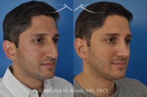 Photo of a patient before and after a procedure. Open Rhinoplasty and Septoplasty for Hump Reduction, Tip Elevation, and Improved Breathing - This procedure involved an open rhinoplasty technique to effectively reduce a prominent nasal hump and elevate a droopy nasal tip for enhanced facial harmony. Additionally, septoplasty was performed to correct nasal septum deviation, improving the patient’s breathing function.