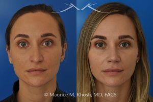 Photo of a patient before and after a procedure. Rhinoplasty to Elevate and Refine the Nasal Tip - This delightful 30 year-old was interested in rhinoplasty in New York, to elevate and refine her nasal tip. An open approach rhinoplasty was used to rotate and shorten the tip. Providing the results which perfectly matched her expectations .