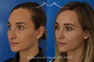 Photo of a patient before and after a procedure. Rhinoplasty to Elevate and Refine the Nasal Tip - This delightful 30 year-old was interested in rhinoplasty in New York, to elevate and refine her nasal tip. An open approach rhinoplasty was used to rotate and shorten the tip. Providing the results which perfectly matched her expectations .