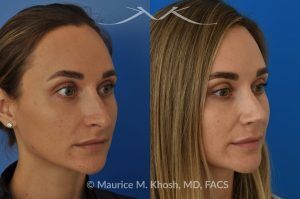 Photo of a patient before and after a procedure. Rhinoplasty to Elevate and Refine the Nasal Tip - This delightful 30 year-old was interested in rhinoplasty in New York, to elevate and refine her nasal tip. An open approach rhinoplasty was used to rotate and shorten the tip. Providing the results which perfectly matched her expectations .