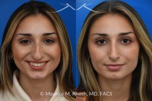 Photo of a patient before and after a procedure. Saddle Nose Rhinoplasty with Rib Cartilage Reconstruction -  This young patient was interested in eliminating her nasal hump and improving her droopy appearing nasal tip. She was also interested in addressing her nasal breathing obstruction. An open approach rhinoplasty was used to achieve a smooth dorsal profile, and elevate and refine her nasal tip. Her deviated septum was also corrected during the surgery.