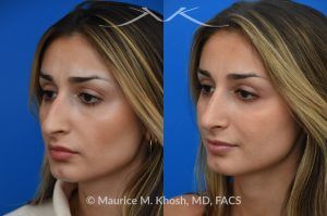 Photo of a patient before and after a procedure. Saddle Nose Rhinoplasty with Rib Cartilage Reconstruction -  This young patient was interested in eliminating her nasal hump and improving her droopy appearing nasal tip. She was also interested in addressing her nasal breathing obstruction. An open approach rhinoplasty was used to achieve a smooth dorsal profile, and elevate and refine her nasal tip. Her deviated septum was also corrected during the surgery.