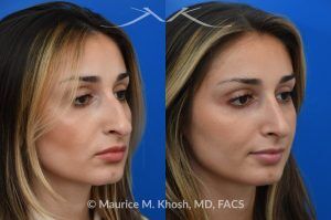 Photo of a patient before and after a procedure. Saddle Nose Rhinoplasty with Rib Cartilage Reconstruction -  This young patient was interested in eliminating her nasal hump and improving her droopy appearing nasal tip. She was also interested in addressing her nasal breathing obstruction. An open approach rhinoplasty was used to achieve a smooth dorsal profile, and elevate and refine her nasal tip. Her deviated septum was also corrected during the surgery.