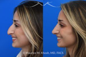 Photo of a patient before and after a procedure. Saddle Nose Rhinoplasty with Rib Cartilage Reconstruction -  This young patient was interested in eliminating her nasal hump and improving her droopy appearing nasal tip. She was also interested in addressing her nasal breathing obstruction. An open approach rhinoplasty was used to achieve a smooth dorsal profile, and elevate and refine her nasal tip. Her deviated septum was also corrected during the surgery.