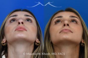 Photo of a patient before and after a procedure. Saddle Nose Rhinoplasty with Rib Cartilage Reconstruction -  This young patient was interested in eliminating her nasal hump and improving her droopy appearing nasal tip. She was also interested in addressing her nasal breathing obstruction. An open approach rhinoplasty was used to achieve a smooth dorsal profile, and elevate and refine her nasal tip. Her deviated septum was also corrected during the surgery.