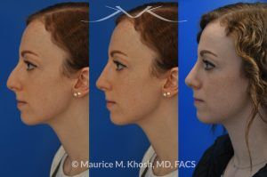 Photo of a patient before and after a procedure. Nasal Hump Reduction and Tip Elevation - This 27 year old requested rhinoplasty in New York to address a large nasal hump and to improve the nasal tip in a subtle and natural manner. The images show her before and after photos 6 months after surgery. The last two images show our computer simulation of the appearance of the bridge of her nose, in the middle images. Note the similarity of the simulation photos to the final outcome. 