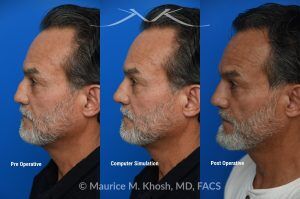 Photo of a patient before and after a procedure. Rib Cartilage Rhinoplasty with Dorsal Hump Reduction and Tip Refinement - Rhinoplasty Using Autologous Rib Cartilage to Correct High Dorsal Septal Deviation Following Unsuccessful Septoplasty, with Simultaneous Dorsal Hump Reduction and Nasal Tip Rotation.