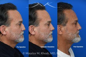 Photo of a patient before and after a procedure. Rib Cartilage Rhinoplasty with Dorsal Hump Reduction and Tip Refinement - Rhinoplasty Using Autologous Rib Cartilage to Correct High Dorsal Septal Deviation Following Unsuccessful Septoplasty, with Simultaneous Dorsal Hump Reduction and Nasal Tip Rotation.