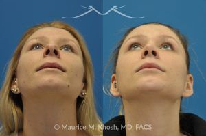 Photo of a patient before and after a procedure. Rhinoplasty and Chin Implant - before-and-after composite photo.