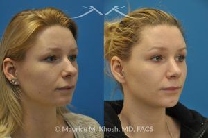 Photo of a patient before and after a procedure. Rhinoplasty and Chin Implant - before-and-after composite photo.