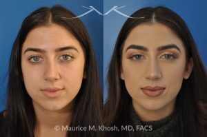 Photo of a patient before and after a procedure. Rhinoplasty and Septoplasty for Hump Removal and Tip Refinement - 21 year old female wanted a nasal hump removed and the tip of her nose refined. She has breathing obstruction due to a crooked septum. She underwent a closed rhinoplasty and septoplasty. during rhinoplasty, the nasal hump was removed, nasal bones were narrowed, and a columellar strut placed to improve her nasal tip position.