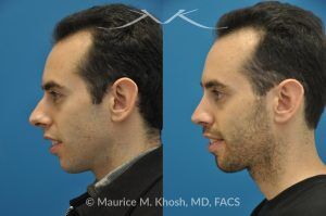 Photo of a patient before and after a procedure. Rhinoplasty for Hump Reduction, Tip Refinement and Nostril Narrowing - This gentleman was interested in rhinoplasty to address a large hump, wide tip, excess nostril show, and wide nostrils. Surgery was performed via the open rhinoplasty approach.