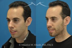 Photo of a patient before and after a procedure. Rhinoplasty for Hump Reduction, Tip Refinement and Nostril Narrowing - This gentleman was interested in rhinoplasty to address a large hump, wide tip, excess nostril show, and wide nostrils. Surgery was performed via the open rhinoplasty approach.