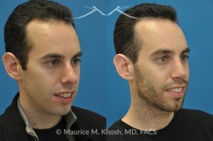 Photo of a patient before and after a procedure. Rhinoplasty for Hump Reduction, Tip Refinement and Nostril Narrowing - This gentleman was interested in rhinoplasty to address a large hump, wide tip, excess nostril show, and wide nostrils. Surgery was performed via the open rhinoplasty approach.