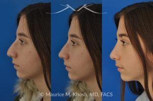 Photo of a patient before and after a procedure. Rhinoplasty for a Refined Nose With Smooth Bridge, Tip Elevation, and Tip Narrowing - before-and-after composite photo.