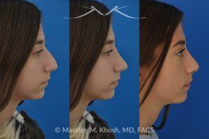 Photo of a patient before and after a procedure. Rhinoplasty for a Refined Nose With Smooth Bridge, Tip Elevation, and Tip Narrowing - before-and-after composite photo.