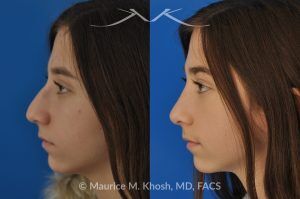 Photo of a patient before and after a procedure. Rhinoplasty for a Refined Nose With Smooth Bridge, Tip Elevation, and Tip Narrowing - before-and-after composite photo.
