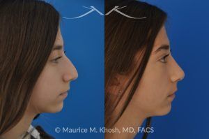 Photo of a patient before and after a procedure. Rhinoplasty for a Refined Nose With Smooth Bridge, Tip Elevation, and Tip Narrowing - before-and-after composite photo.