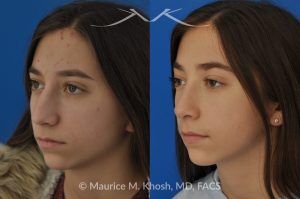 Photo of a patient before and after a procedure. Rhinoplasty for a Refined Nose With Smooth Bridge, Tip Elevation, and Tip Narrowing - before-and-after composite photo.