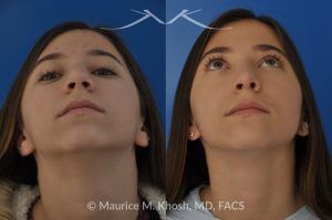 Photo of a patient before and after a procedure. Rhinoplasty for a Refined Nose With Smooth Bridge, Tip Elevation, and Tip Narrowing - before-and-after composite photo.