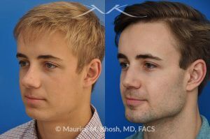 Photo of a patient before and after a procedure. Rhinoplasty for Crooked Nose and Nasal Obstruction, 10 Years Post Op - 10 year post op results after rhinoplasty to straighten a crooked nose and alleviate severe nasal obstruction. An open approach rhinoplasty was used to achieve these results. 