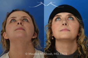 Photo of a patient before and after a procedure. Rhinoplasty to Correct Nasal Hump and Drooping Tip - This amazing 22 year-old was bothered by the droopiness of the tip of her nose and the large nasal hump. We used the open approach to perform septoplasty, dorsal reduction, caudal septum shortening, cephalic trimming, and alar strut grafts. She is delighted with the improved breathing, and loves the new shape of her tip and the bridge of her nose. 