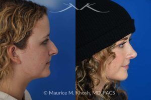 Photo of a patient before and after a procedure. Rhinoplasty to Correct Nasal Hump and Drooping Tip - This amazing 22 year-old was bothered by the droopiness of the tip of her nose and the large nasal hump. We used the open approach to perform septoplasty, dorsal reduction, caudal septum shortening, cephalic trimming, and alar strut grafts. She is delighted with the improved breathing, and loves the new shape of her tip and the bridge of her nose. 