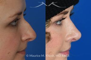 Photo of a patient before and after a procedure. Rhinoplasty to Correct Nasal Hump and Drooping Tip - This amazing 22 year-old was bothered by the droopiness of the tip of her nose and the large nasal hump. We used the open approach to perform septoplasty, dorsal reduction, caudal septum shortening, cephalic trimming, and alar strut grafts. She is delighted with the improved breathing, and loves the new shape of her tip and the bridge of her nose. 