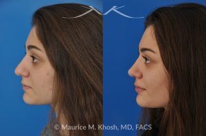 Photo of a patient before and after a procedure. Rhinoplasty to Straighten a Crooked Nose and Refine the Nasal Profile - before-and-after composite photo.