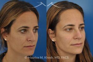 Photo of a patient before and after a procedure. Rhinoplasty for Bridge Straightening and Functional Correction - This procedure corrected the nasal bridge asymmetry and improved the patient’s breathing function.