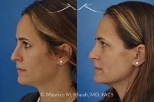 Photo of a patient before and after a procedure. Rhinoplasty for Bridge Straightening and Functional Correction - This procedure corrected the nasal bridge asymmetry and improved the patient’s breathing function.