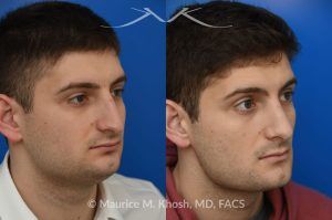Photo of a patient before and after a procedure. Rhinoplasty for Nasal Obstruction and Aesthetic Correction - This patient's main complaint was bilateral severe nasal obstruction. His secondary concern was the dorsal hump and droopy nasal tip. We used an open rhinoplasty approach to straighten his deviated septum, lower the dorsal hump and place bilateral spreader grafts to widen the internal nasal valve to enhance his breathing. The nasal tip was reduced in size and rotated to achieve the desired tip position. 