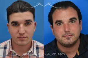 Photo of a patient before and after a procedure. 9 Years Post-Rhinoplasty After Nasal Fracture - These photos show the long-term result—9 years after rhinoplasty to smooth the nasal bridge and refine tip position. The patient had a previous nasal fracture that affected both the appearance and alignment of the nose.